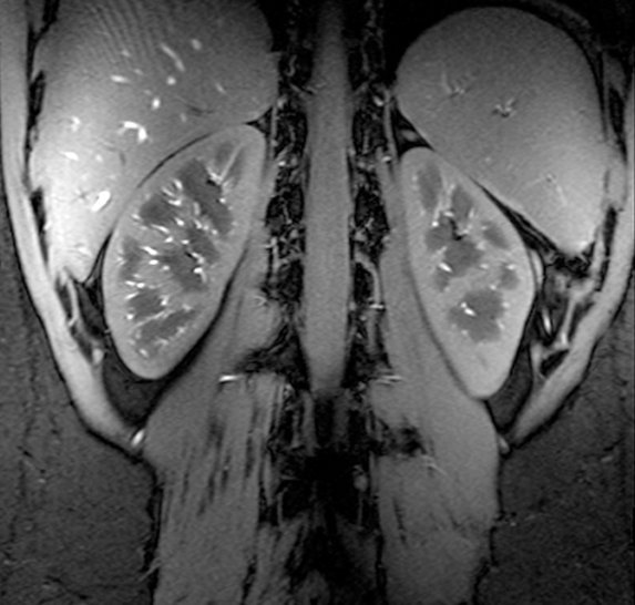 MRI image of both kidneys